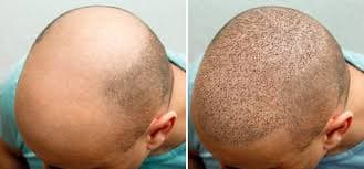 Hair Transplant Turkey – Transform Your Hair, Transform Your Life
