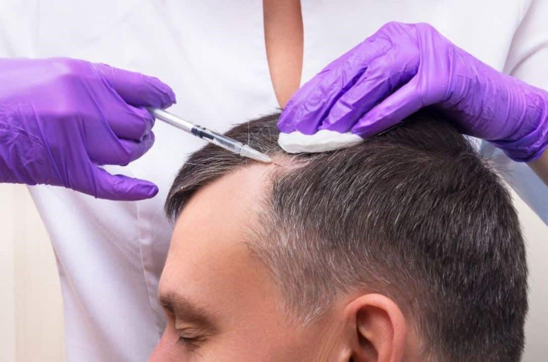 Hair Transplant London – Modern Solutions for Hair Loss