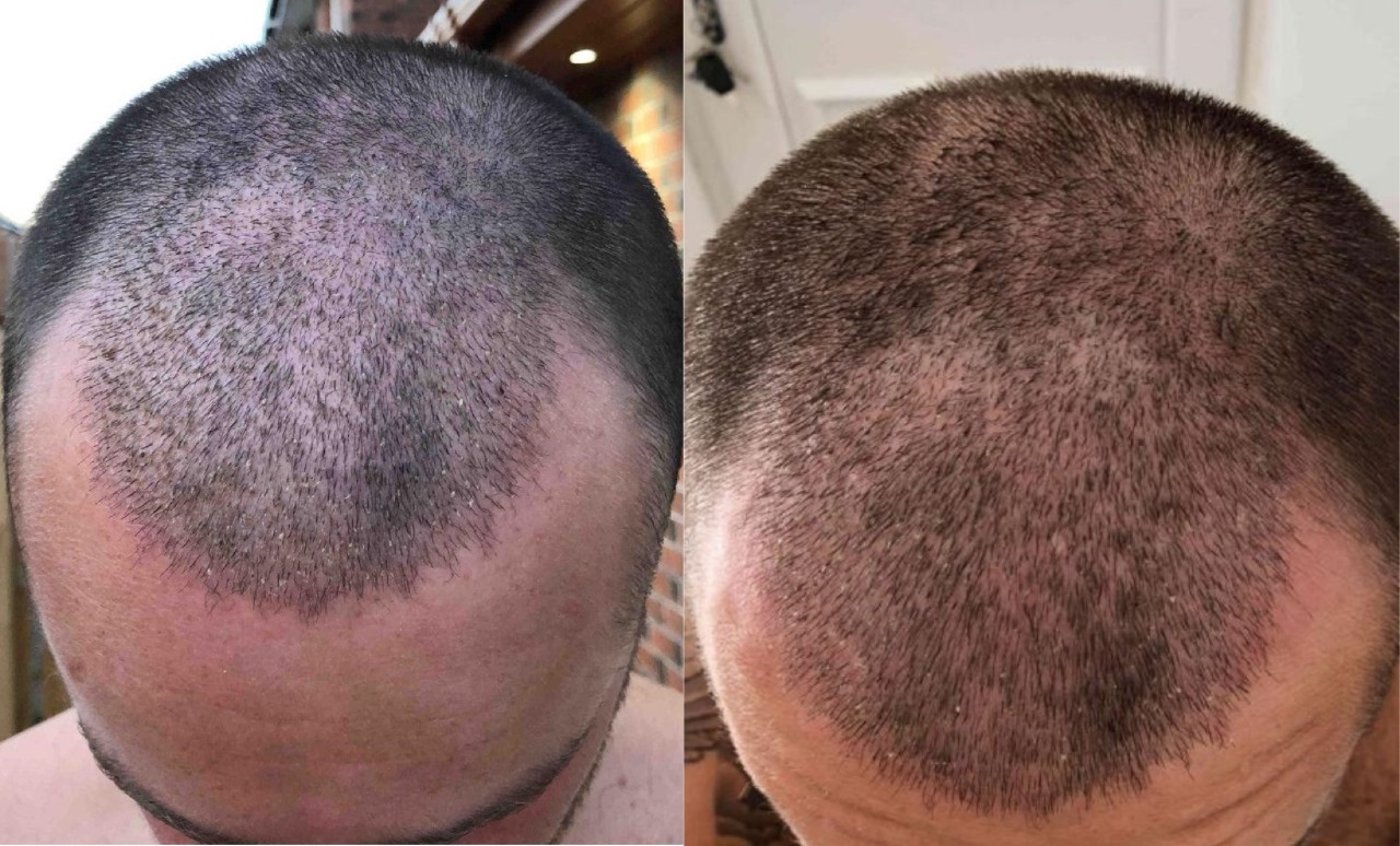Why Westminster Medical Group® Leads in Hair Transplant London