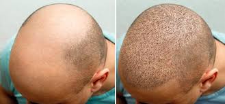 Hair Transplant Turkey – Transform Your Hair, Transform Your Life