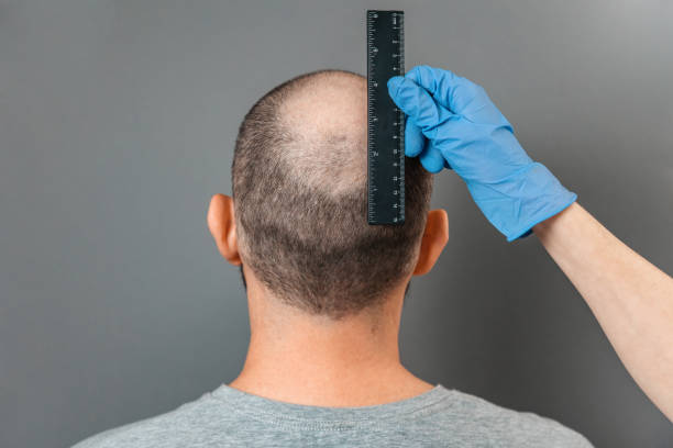 Hair Transplant Price Guide for 2026